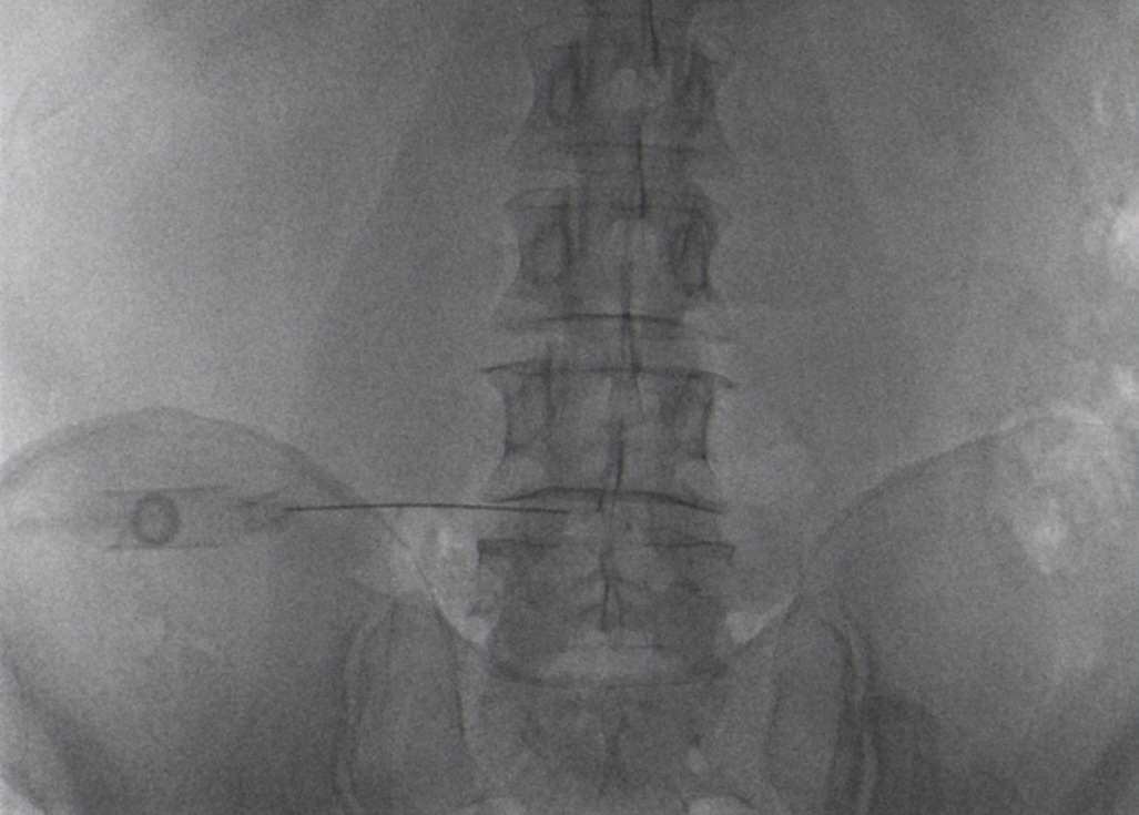 Infiltrazioni colonna vertebrale e Ozonoterapia